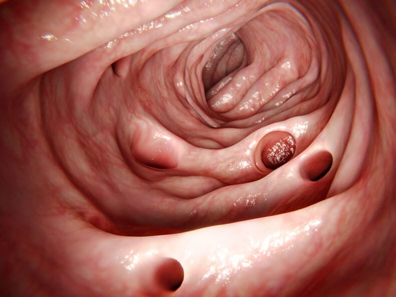 Diverticular Disease / Diverticulitis