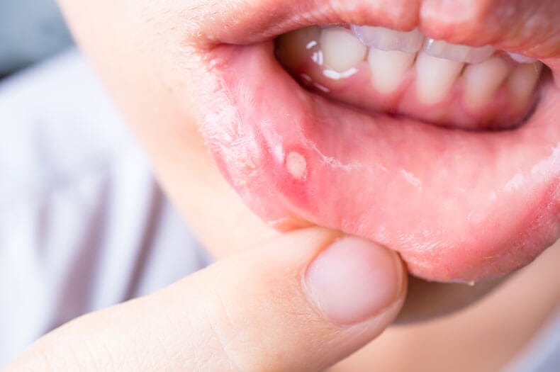 vitamin c deficiency lips Here's how to tell whether your dry lips signal a nutrient deficiency and  how to find relief: https://bit.ly/4eOarBl main image 0