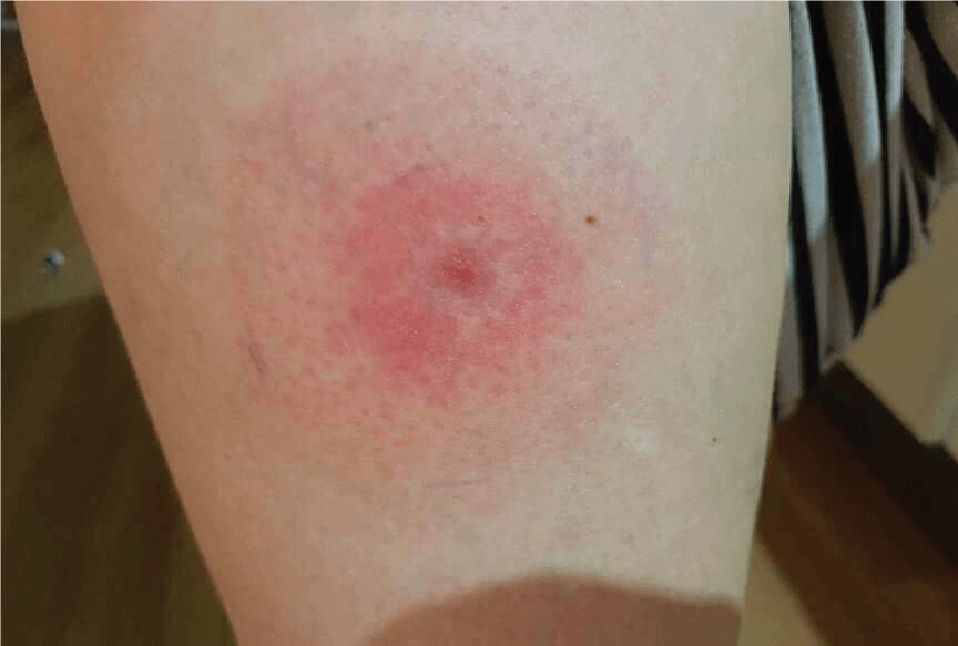 Lyme Disease Bulls-eye rash