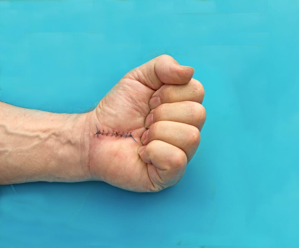 Carpal Tunnel Syndrome