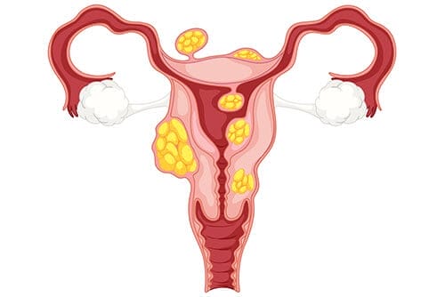 Uterine Fibroids