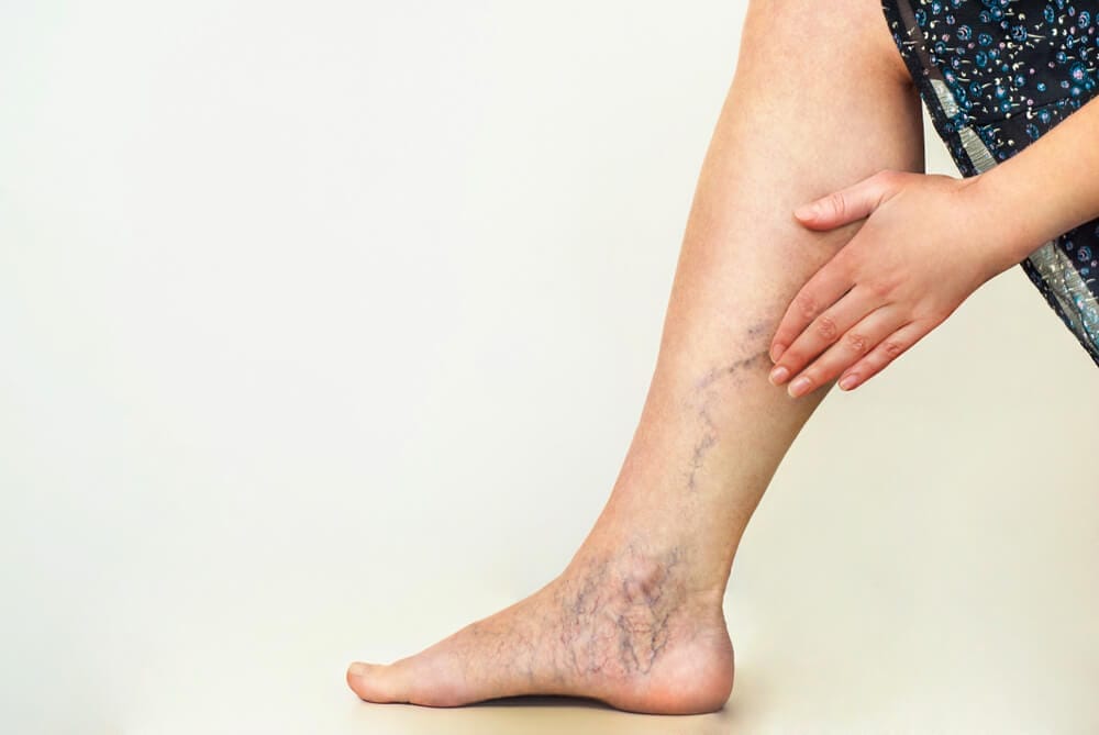 Varicose Veins & Hemorrhoids