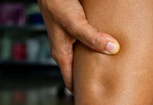 Edema