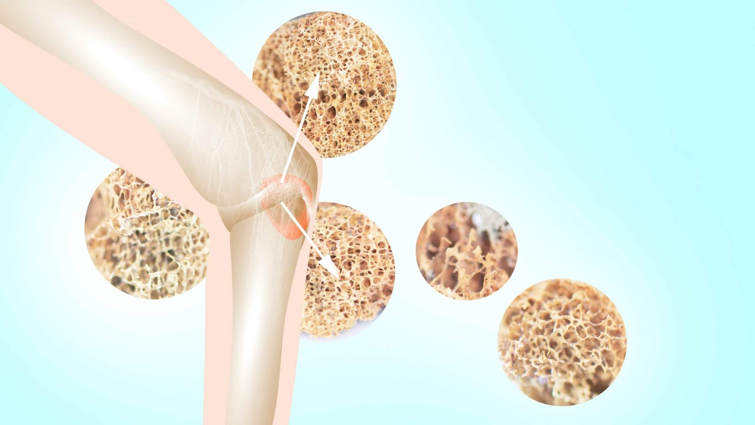 Preventing Osteoporosis The Natural Way